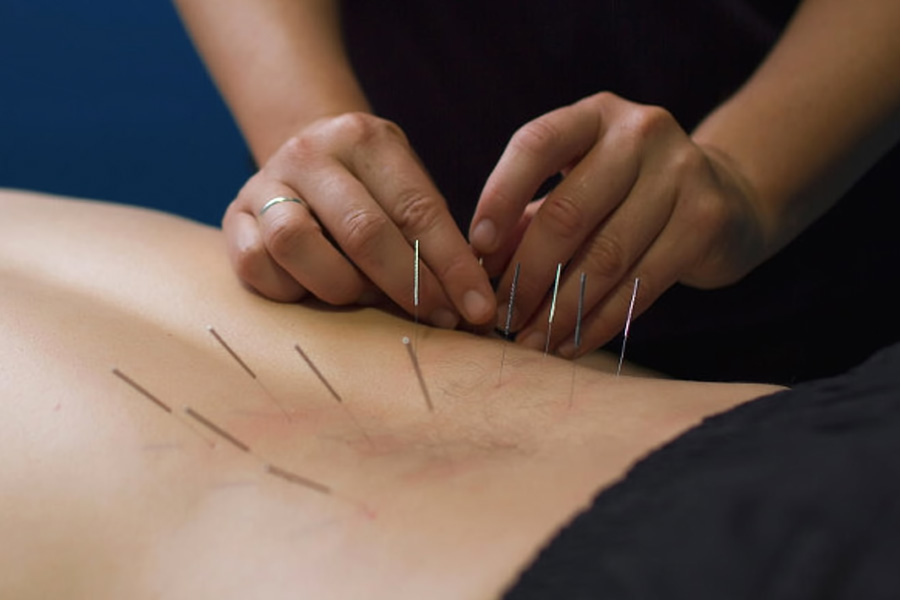 dry-needling Dry Needling & Cupping Therapy Springfield NJ